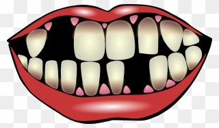 Kiss Clip Art - Tooth Decay Clipart - Png Download