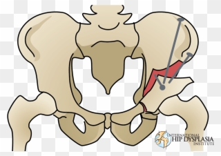 In The Meantime, Dr - Triple Pelvic Osteotomy Human Clipart
