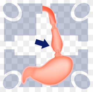 What Is Peroral Endoscopic Myotomy Clipart