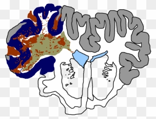 Traumatic Brain Injury Considered The Most Complex - Traumatic Brain Injury Clipart