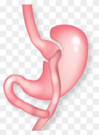 Gastric Bypass - Gastric Bypass Surgery Clipart