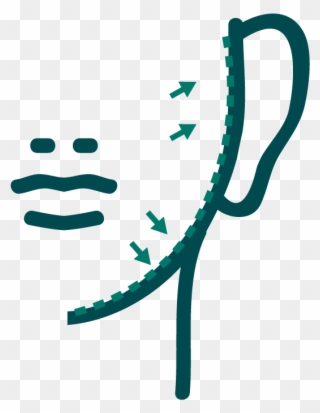 Face Lift2-01 - Botulinum Toxin Clipart