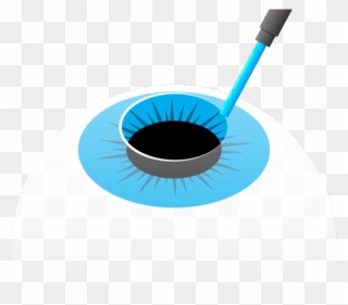 Immediately After Treatment, A Bandage Contact Lens - Circle Clipart