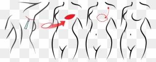 Icap Procedure - Flap Clipart