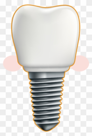 Dental Implant - Illustration Clipart