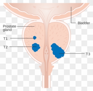Prostate Cancer Affects Almost A Quarter Of A Million - Prostate Clipart