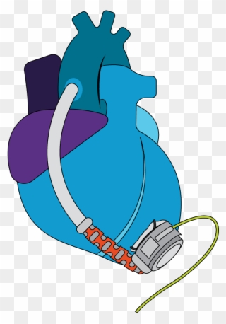 Example Of A Continuous Flow Lvad - Ventricular Assist Device Clipart