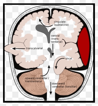 Neurology Review - Types Of Brain Herniation Clipart