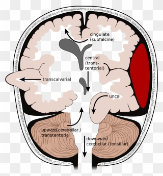 Brain Herniation Types-2 - Types Of Brain Herniation Clipart