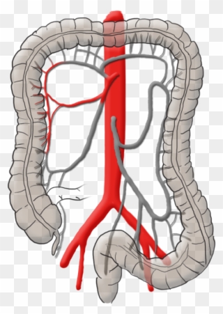 Right Colic Artery - Kolonkarzinom Operation Clipart