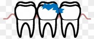 It Never Heals Spontaneously, But Leads To Complications - Tooth Decay Clipart
