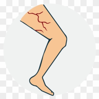 Varicose Vein Clipart