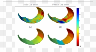 Gender-specific Changes In Medial Femoral Cartilage Clipart