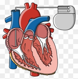 Pacemaker Information And Support Pt 2 Survey Clipart