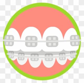 Blue Wave Orthodontics Invisalign And Braces Tampa - Dental Braces Clipart