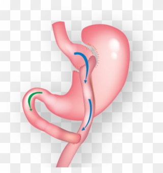 Demonstration Of Gastric Bypass Surgery Clipart