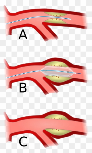 Balloon Angioplasty - Percutaneous Coronary Intervention Hd Clipart