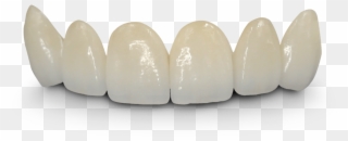 Teeth Png Hd - Crown And Bridge Hd Clipart