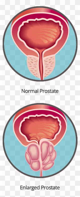 Prostate Cancer Can Be Found Early - Circle Clipart