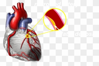 Moderate - Coronary Arteries Without Label Clipart