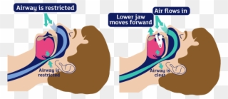 Loud Snoring And Obstructive Sleep Apnoea - Graphic Design Clipart