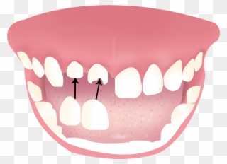 Generally A Crown Is Received In A Two-stage Process - Dentures Clipart