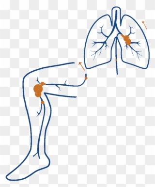 What Are Dvt And Pe Clipart