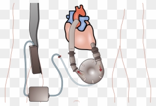 In The Current Issue Of The Journal Of Heart And Lung - Aparato Para El Corazon Clipart