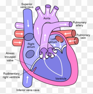 File - Tricuspid Atresia - Svg - Diagram Of The Heart Clipart