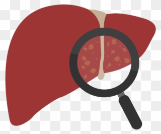 Gallstones In The Liver Clipart
