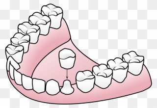 Tooth Clipart Crown Royalty Free Library Porcelain - Components Of A Denture - Png Download