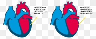 Congestive Heart Failure Drawing Clipart