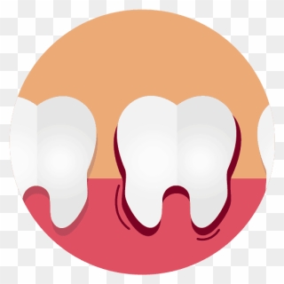 Swollen Gums Due To Gingivitis Graphic Clipart