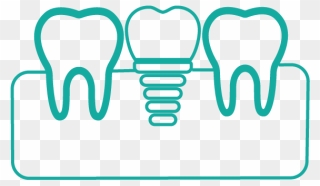 Single Tooth Implants Clipart