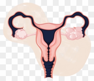 Pcos And Pregnancy - Female Reproductive System Cartoon Clipart