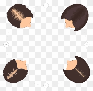 Women Hair Loss Stage Clipart