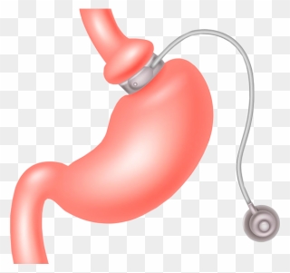 Adjustable Gastric Band Clipart