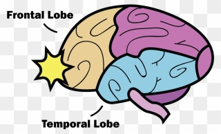 Clipart Brain Concussion - Frontal And Temporal Lobes Concussion - Png Download