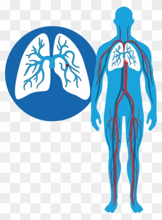 Dvt And Pe Diagram - Pulmonary Embolism And Dvt Clipart