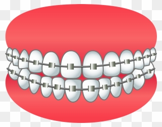 Dental Braces Clipart - Dental Braces - Png Download