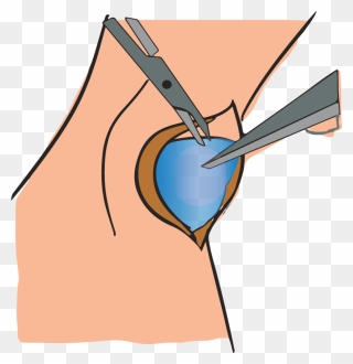 Removing Ganglion Cyst Through Surgery Clipart