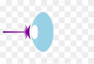 Transparent Laser Eye Surgery Clipart - Circle - Png Download