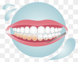 Removing Plaque And Tartar Stuck Above And Below The Clipart