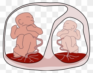 Twin To Twin Transfusion Syndrome Clipart