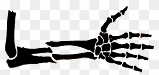 Broken Arm - Broken Arm Drawing Clipart