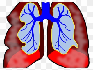 Allergic Asthma Signs Symptoms And Treatments Check - Clipart Lung Cancer Png Transparent Png