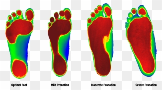 Foot Ranging From Least Severe To Most According To - Custom Orthotics Clipart