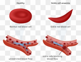 Cotton Clipart White Blood Cell - Normal Red Blood Cell And Sickle Cell - Png Download
